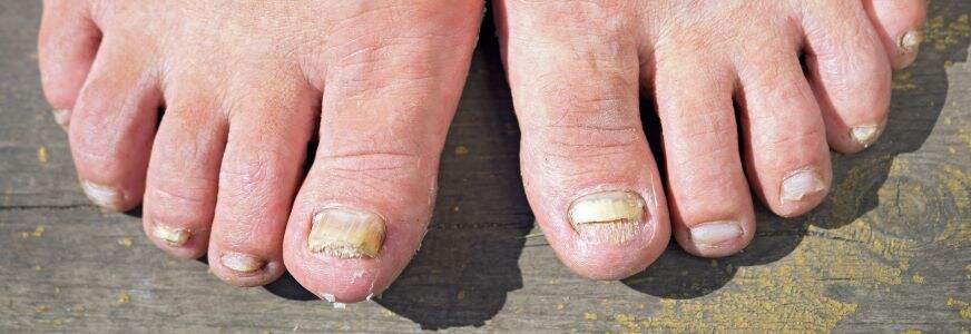 Toenail Fungus: What It Is, Why Natural Remedies Is Your Best Bet? – The  Amino Company