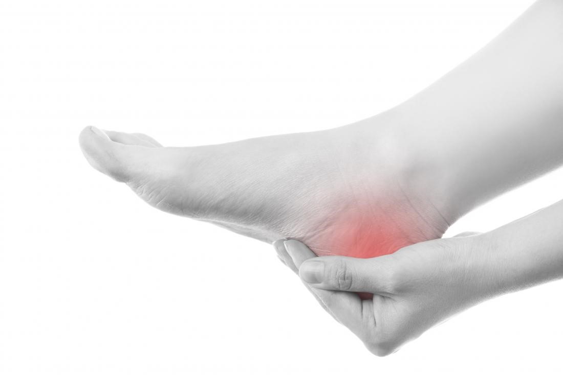 Plantar Fasciitis