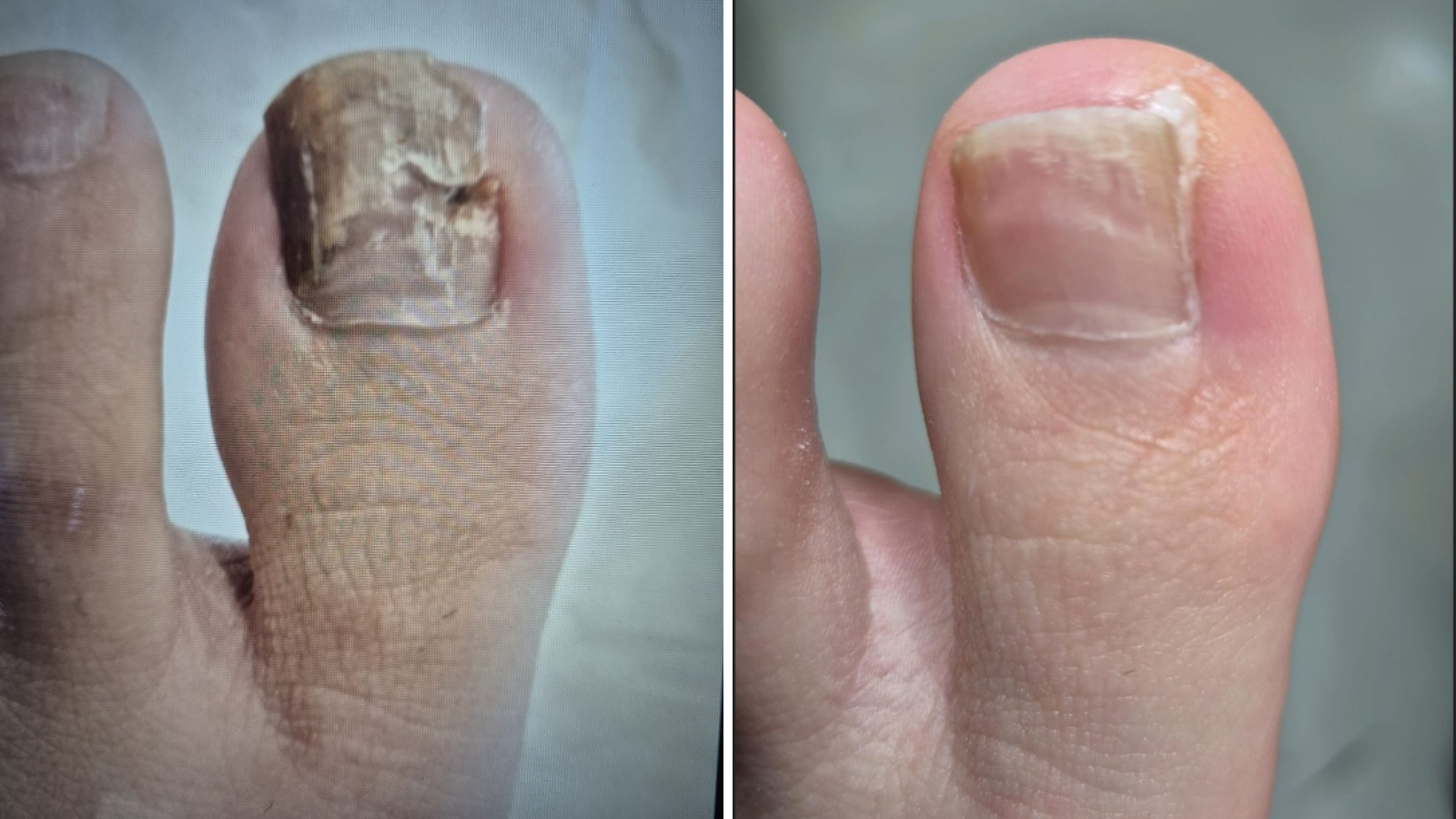 essex footcare fungal nails