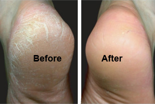 Dry Cracked Feet or Dry Cracked Heels? [Causes & Best Treatment]