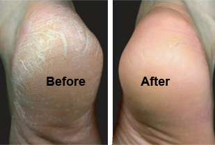 Dry deals heel treatment