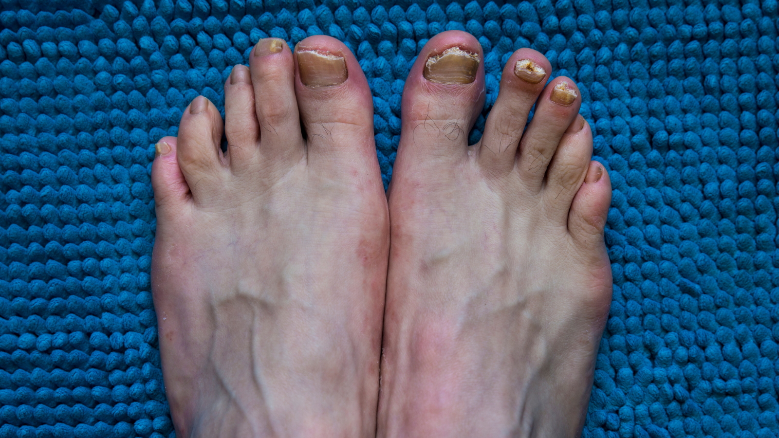 fungal toenails