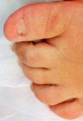 Unsightly Toe nails before treatment